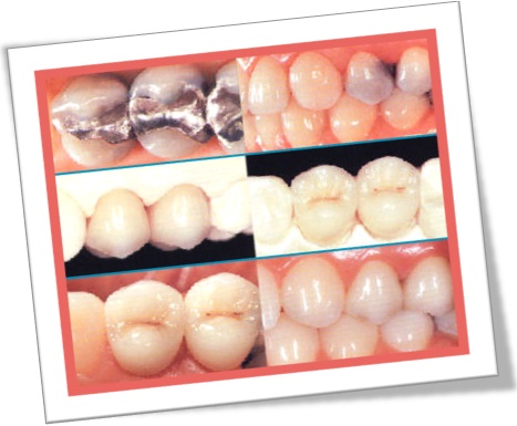 dentista problemas odontológicos, restauração, deterioração, placa, cárie