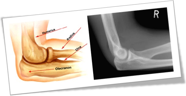 cotovelo, elbow, olecrânio, olecranon, raixo x, anatomia, corpo humano