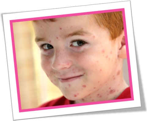 garoto com catapora, boy with chichenpox, doença da pele