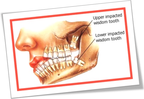 upper and lower impacted wisdom tooth teeth dentes sisos superior e inferior impactados