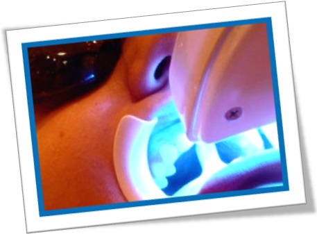 laser teeth whitening, clareamento dental a laser, dentista, odontologia